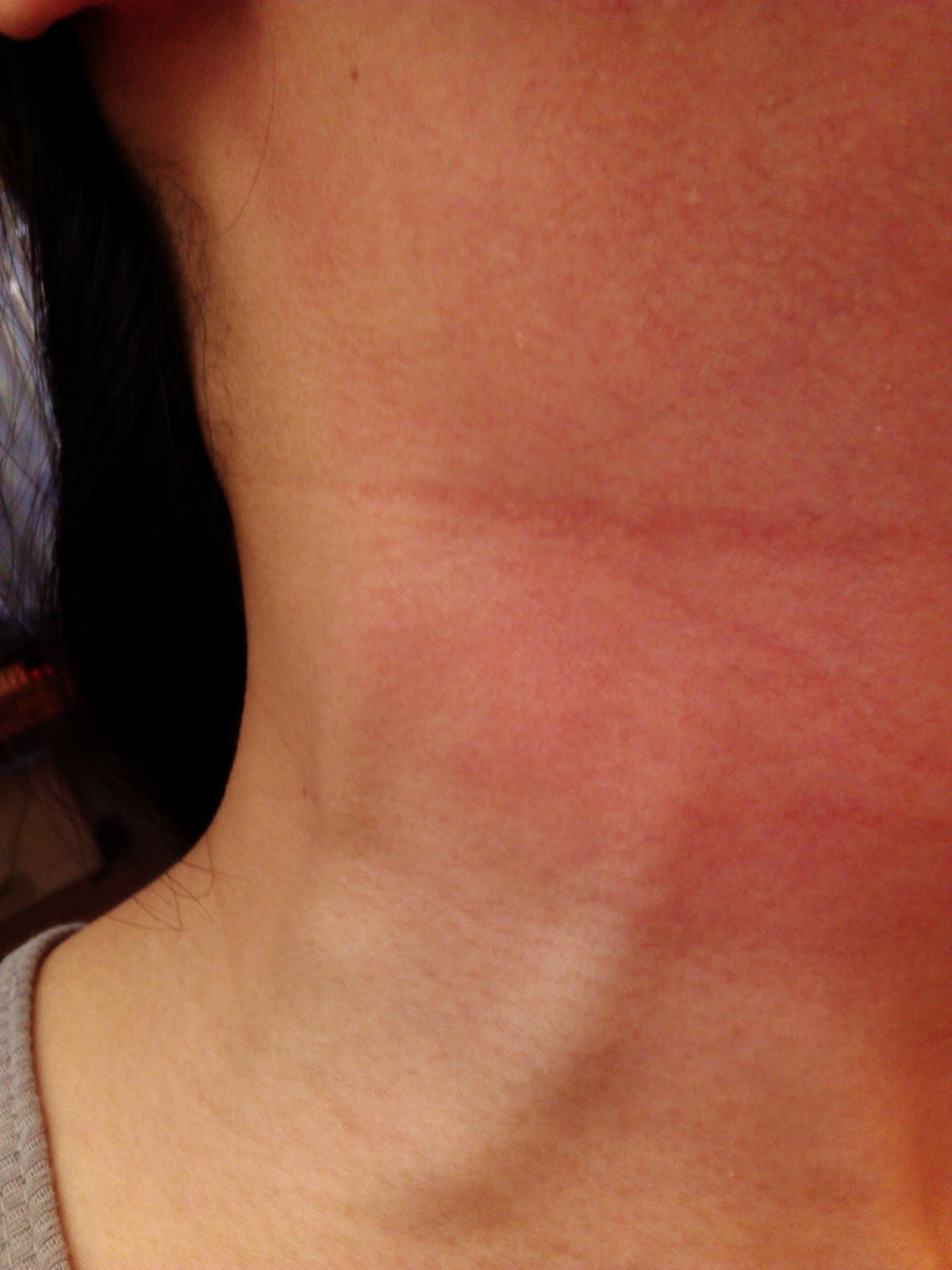 My Staph Story My Staph Story