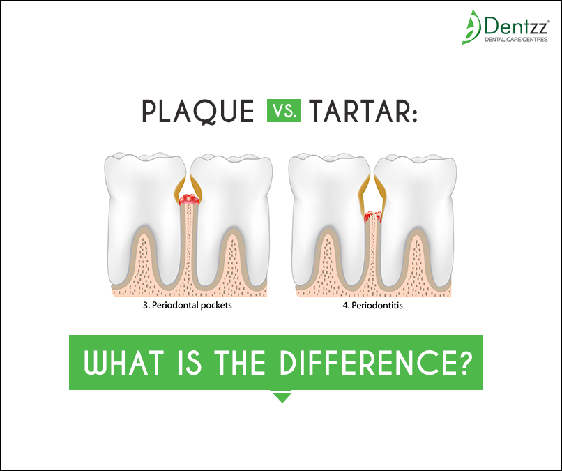 Dentzz Dental Know More About Plaque and Tartar and What