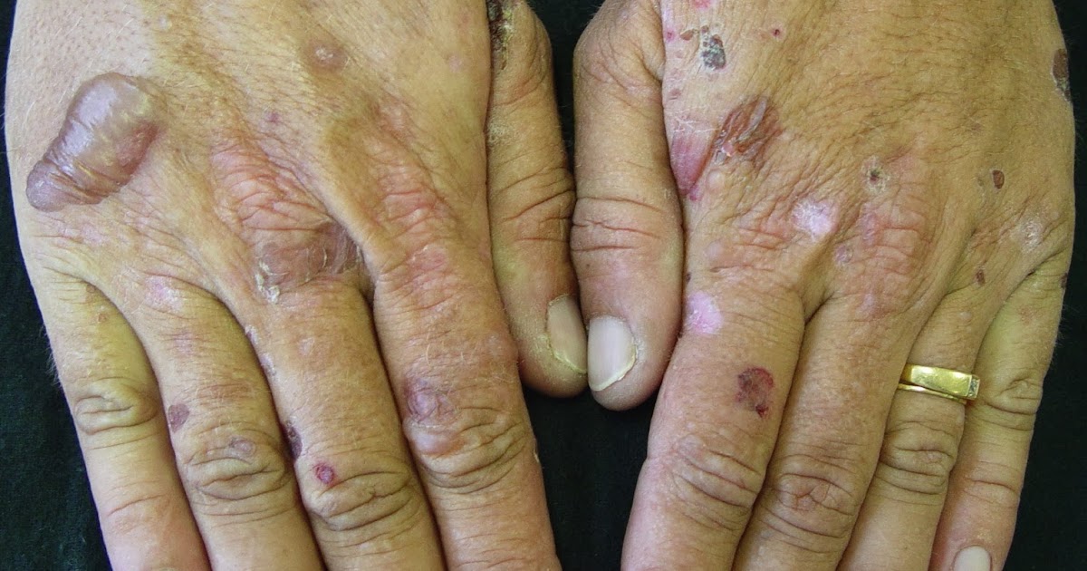 ND Clinical Board Review: Porphyria