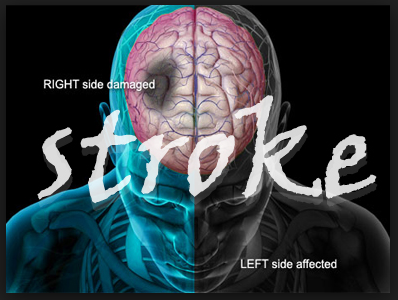 Penyebab Penyakit Stroke Penyebab Penyakit Stroke