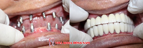Mất nguyên hàm cần cấy bao nhiêu trụ Implant MẤT NGUYÊN HÀM CẦN CẤY BAO NHIÊU TRỤ IMPLANT