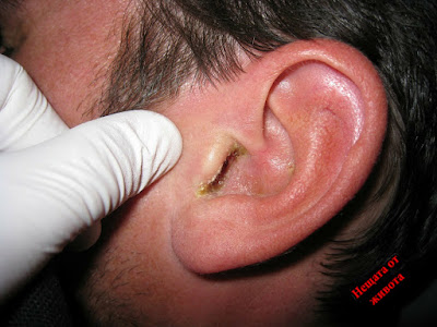 Домашни средства за лечение на възпаление на средното ухо(отит)