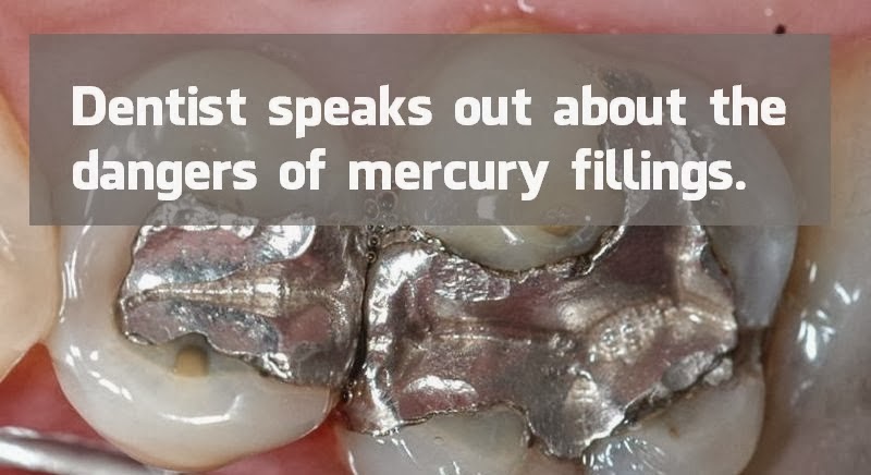  Dentist speaks out about the dangers of Dental Amalgam
