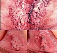 Kapsul Dan Salep Obat Daging Tumbuh/Kutil Pada Vagina Yang Ampuh Kapsul Dan Salep Obat Daging Tumbuh/Kutil Pada Vagina Yang Ampuh