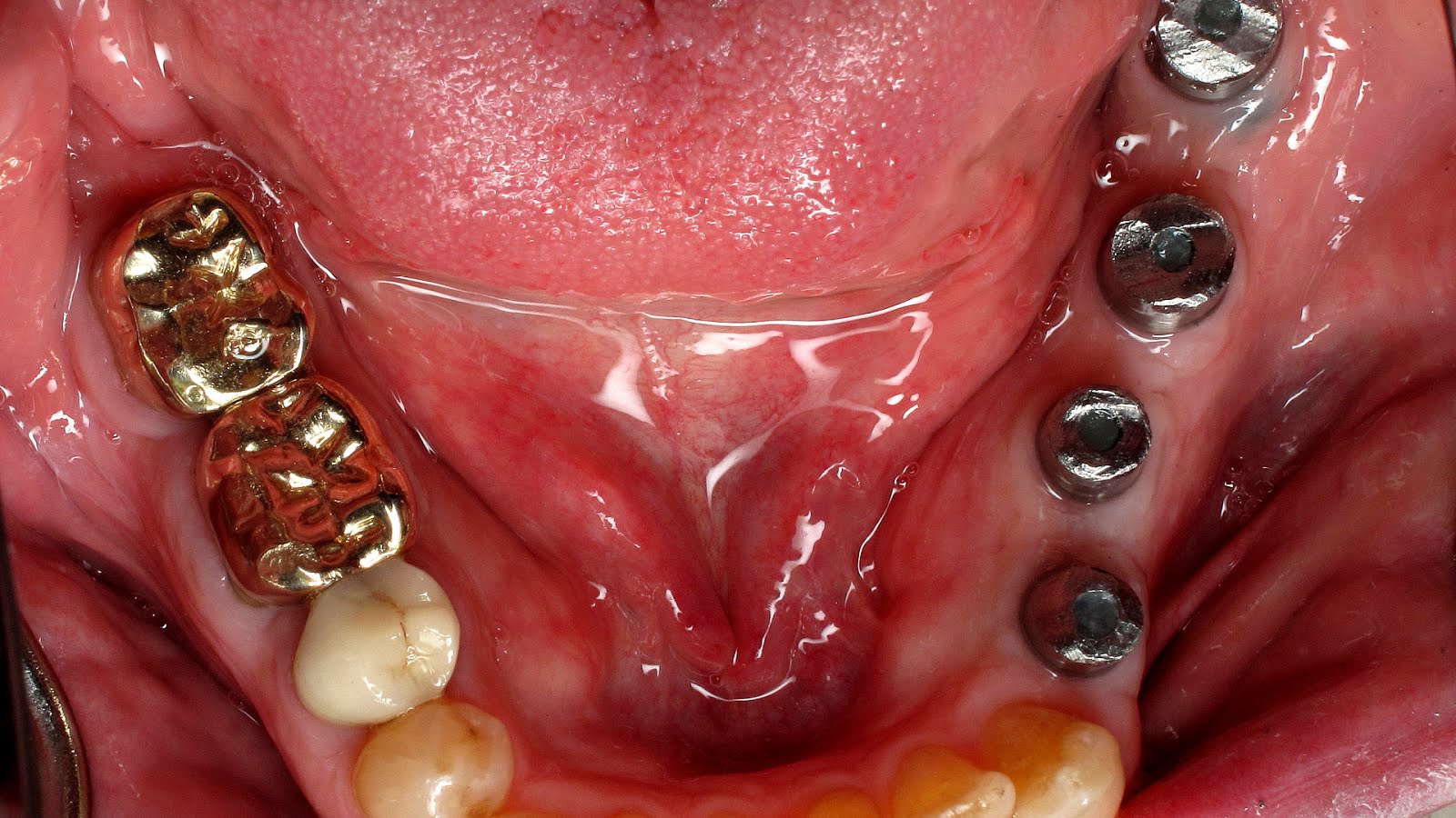 Permanent Gold Teeth Cost Gold Choices Permanent Gold Teeth Cost Gold Choices