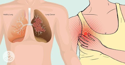 Mesothelioma lawyer Mesothelioma lawyer
