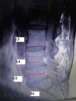 Before - yuck.  No lumbar curve, no discs left.  Bones growing where they don't belong for support.