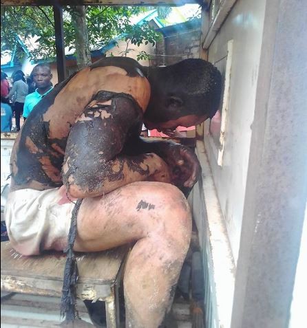 Man Suffers 100% Degree Burnt While Trying To Steal From A Transformer
