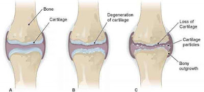 total knee replacement best orthopedic doctor in Cavite