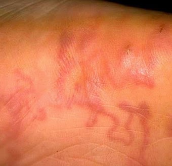 144 PENYAKIT: STRONGILODIASIS