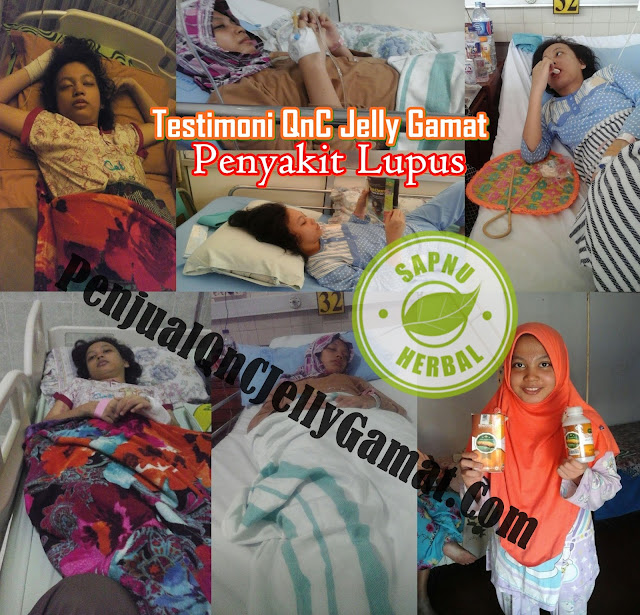 Obat Lupus Herbal Terbukti Mujarab ~ TESTIMONI QNC JELLY GAMAT Obat Lupus Herbal Terbukti Mujarab ~ TESTIMONI QNC JELLY GAMAT