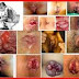 Obat Untuk Ambeien Yang Berdarah thumbnail