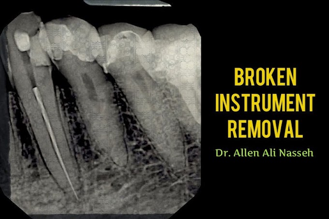 ENDODONTIC: Broken Instrument Removal - Clinical Case of Dr. Allen Ali Nasseh
