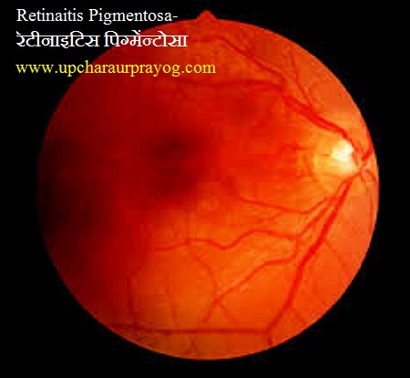Retinaitis Pigmentosa