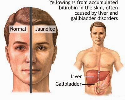 Jaundice  Jaundice is not a disease but rather a sign that can occur in many different diseases. Jaundice is the yellowish staining of the skin and sclera (the whites of the eyes) that is caused by high levels in blood of the chemical bilirubin. The colour of the skin and sclera vary depending on the level of bilirubin. When the bilirubin level is mildly elevated, they are yellowish. When the bilirubin level is high, they tend to be brown. Causes of Jaundice?  Bilirubin comes from red blood cells. When red blood cells get old, they are destroyed. Haemoglobin, the iron-containing chemical in red blood cells that carries oxygen, is released from the destroyed red blood cells after the iron it contains is removed. The chemical that remains in the blood after the iron is removed becomes bilirubin.  The liver has many functions. One of the liver's functions is to produce and secrete bile into the intestines to help digest dietary fat. Another is to remove toxic chemicals or waste products from the blood, and bilirubin is a waste product. The liver removes bilirubin from the blood. After the bilirubin has entered the liver cells, the cells conjugate (attaching other chemicals, primarily glucuronic acid) to the bilirubin, and then secrete the bilirubin/glucuronic acid complex into bile. The complex that is secreted in bile is called conjugated bilirubin. The conjugated bilirubin is eliminated in the feces. (Bilirubin is what gives feces its brown colour.) Conjugated bilirubin is distinguished from the bilirubin that is released from the red blood cells and not yet removed from the blood which is termed unconjugated bilirubin.  Jaundice occurs when there is  1. Too much bilirubin being produced for the liver to remove from the blood. (For example, patients with haemolytic anaemia have an abnormally rapid rate of destruction of their red blood cells that releases large amounts of bilirubin into the blood),  2. A defect in the liver that prevents bilirubin from being removed from the blood, converted to bilirubin/glucuronic acid (conjugated) or secreted in bile, or  3. Blockage of the bile ducts that decreases the flow of bile and bilirubin from the liver into the intestines. (For example, the bile ducts can be blocked by cancers, gallstones, or inflammation of the bile ducts).  The decreased conjugation, secretion, or flow of bile that can result in jaundice is referred to as cholestasis: however, cholestasis does not always result in jaundice. Problem due to jaundice Jaundice or cholestasis, by themselves, causes few problems (except in the newborn, and jaundice in the newborn is different than most other types of jaundice, as discussed later.) Jaundice can turn the skin and sclera yellow. In addition, stool can become light in colour, even clay-colored because of the absence of bilirubin that normally gives stool its brown colour. The urine may turn dark or brownish in colour. This occurs when the bilirubin that is building up in the blood begins to be excreted from the body in the urine. Just as in feces, the bilirubin turns the urine brown.  Besides the cosmetic issues of looking yellow and having dark urine and light stools, the symptom that is associated most frequently associated with jaundice or cholestasis is itching, medically known as pruritus. The itching associated with jaundice and cholestasis can sometimes be so severe that it causes patients to scratch their skin "raw," have trouble sleeping, and, rarely, even to commit suicide.  It is the disease causing the jaundice that causes most problems associated with jaundice. Specifically, if the jaundice is due to liver disease, the patient may have symptoms or signs of liver disease or cirrhosis. (Cirrhosis represents advanced liver disease.) The symptoms and signs of liver disease and cirrhosis include fatigue, swelling of the ankles, muscle wasting, ascites (fluid accumulation in the abdominal cavity), mental confusion or coma, and bleeding into the intestines.  If the jaundice is caused by blockage of the bile ducts, no bile enters the intestine. Bile is necessary for digesting fat in the intestine and releasing vitamins from within it so that the vitamins can be absorbed into the body. Therefore, blockage of the flow of bile can lead to deficiencies of certain vitamins. For example, there may be a deficiency of vitamin K that prevents proteins that are needed for normal clotting of blood to be made by the liver, and, as a result, uncontrolled bleeding may occur.  What diseases cause jaundice?   Increased production of bilirubin  There are several uncommon conditions that give rise to over-production of bilirubin. The bilirubin in the blood in these conditions usually is only mildly elevated, and the resultant jaundice usually is mild and difficult to detect. These conditions include:  1. Rapid destruction of red blood cells (referred to as hemolysis),  2. A defect in the formation of red blood cells that leads to the over-production of haemoglobin in the bone marrow (called ineffective erythropoiesis), or  3. Absorption of large amounts of haemoglobin when there has been much bleeding into tissues (e.g., from hematomas, collections of blood in the tissues).  Acute inflammation of the liver  Any condition in which the liver becomes inflamed can reduce the ability of the liver to conjugate (attach glucuronic acid to) and secrete bilirubin. Common examples include acute viral hepatitis, alcoholic hepatitis, and Tylenol-induced liver toxicity.  Chronic liver diseases  Chronic inflammation of the liver can lead to scarring and cirrhosis, and can ultimately result in jaundice. Common examples include chronic hepatitis B and C, alcoholic liver disease with cirrhosis, and autoimmune hepatitis.  Infiltrative diseases of the liver  Infiltrative diseases of the liver refer to diseases in which the liver is filled with cells or substances that don't belong there. The most common example would be metastatic cancer to the liver, usually from cancers within the abdomen. Uncommon causes include a few diseases in which substances accumulate within the liver cells, for example, iron (hemochromatosis), alpha-one antitrypsin (alpha-one antitrypsin deficiency), and copper (Wilson's disease).  Inflammation of the bile ducts  Diseases causing inflammation of the bile ducts, for example, primary biliary cirrhosis or sclerosing cholangitis and some drugs, can stop the flow of bile and elimination of bilirubin and lead to jaundice.  Blockage of the bile ducts  The most common causes of blockage of the bile ducts are gallstones and pancreatic cancer. Less common causes include cancers of the liver and bile ducts.  Drugs  Many drugs can cause jaundice and/or cholestasis. Some drugs can cause liver inflammation (hepatitis) similar to viral hepatitis. Other drugs can cause inflammation of the bile ducts, resulting in cholestasis and/or jaundice. Drugs also may interfere directly with the chemical processes within the cells of the liver and bile ducts that are responsible for the formation and secretion of bile to the intestine. As a result, the constituents of bile, including bilirubin, are retained in the body. The best example of a drug that causes this latter type of cholestasis and jaundice is oestrogen. The primary treatment for jaundice caused by drugs is discontinuation of the drug. Almost always the bilirubin levels will return to normal within a few weeks, though in a few cases it may take several months.  Genetic disorders  There are several rare genetic disorders present from birth that give rise to jaundice. Crigler-Najjar syndrome is caused by a defect in the conjugation of bilirubin in the liver due to a reduction or absence of the enzyme responsible for conjugating the glucuronic acid to bilirubin. Dubin-Johnson and Rotor's syndromes are caused by abnormal secretion of bilirubin into bile.   The only common genetic disorder that may cause jaundice is Gilbert's syndrome which affects approximately 7% of the population. Gilbert's syndrome is caused by a mild reduction in the activity of the enzyme responsible for conjugating the glucuronic acid to bilirubin. The increase in bilirubin in the blood usually is mild and infrequently reaches levels that cause jaundice. Gilbert's syndrome is a benign condition that does not cause health problems.  Developmental abnormalities of bile ducts  There are rare instances in which the bile ducts do not develop normally and the flow of bile is interrupted. Jaundice frequently occurs. These diseases usually are present from birth though some of them may first be recognized in childhood or even adulthood. Cysts of the bile duct (choledochal cysts) are an example of such a developmental abnormality. Another example is Caroli's disease.  Jaundice of pregnancy  Most of the diseases discussed previously can affect women during pregnancy, but there are some additional causes of jaundice that are unique to pregnancy.  Cholestasis of pregnancy. Cholestasis of pregnancy is an uncommon condition that occurs in pregnant women during the third trimester. The cholestasis is often accompanied by itching but infrequently causes jaundice. The itching can be severe. Pregnant women with cholestasis usually do well although they may be at greater risk for developing gallstones. More importantly, there appears to be an increased risk to the foetus for developmental abnormalities. Cholestasis of pregnancy is more common in certain groups, particularly in Scandinavia and Chile, and tends to occur with each additional pregnancy. There also is an association between cholestasis of pregnancy and cholestasis caused by oral estrogens, and it has been hypothesized that it is the increased estrogens during pregnancy that are responsible for the cholestasis of pregnancy.  Pre-eclampsia. Pre-eclampsia, previously called toxaemia of pregnancy is a disease that occurs during the second half of pregnancy and involves several systems within the body, including the liver. It may result in high blood pressure, fluid retention, and damage to the kidneys as well as anaemia and reduced numbers of platelets due to destruction of red blood cells and platelets. It often causes problems for the foetus. Although the bilirubin level in the blood is elevated in pre-eclampsia, it usually is mildly elevated, and jaundice is uncommon. Treatment of pre-eclampsia usually involves delivery of the foetus as soon as possible if the foetus is mature.  Acute fatty liver of pregnancy. Acute fatty liver of pregnancy (AFLP) is a very serious complication of pregnancy of unclear cause that often is associated with pre-eclampsia. It occurs late in pregnancy and results in failure of the liver. It can almost always be reversed by immediate delivery of the foetus. There is an increased risk of infant death. Jaundice is common, but not always present in AFLP. Treatment usually involves delivery of the foetus as soon as possible.  Treatment  Homeopathy treatment helps for Jaundice   Jaundice Homeopathy Treatment  Symptomatic Homeopathy works well for Jaundice - Hepatitis, So its good to consult a experienced Homeopathy physician without any hesitation.     Whom to contact for Jaundice - Hepatitis  Treatment  Dr.Senthil Kumar Treats many cases of Jaundice - Hepatitis, In his medical professional experience with successful results. Many patients get relief after taking treatment from Dr.Senthil Kumar.  Dr.Senthil Kumar visits Chennai at Vivekanantha Homeopathy Clinic, Velachery, Chennai 42. To get appointment please call 9786901830, +91 94430 54168 or mail to consult.ur.dr@gmail.com,    For more details & Consultation Feel free to contact us. Vivekanantha Clinic Consultation Champers at Chennai:- 9786901830  Panruti:- 9443054168  Pondicherry:- 9865212055 (Camp) Mail : consult.ur.dr@gmail.com, homoeokumar@gmail.com   For appointment please Call us or Mail Us  For appointment: SMS your Name -Age – Mobile Number - Problem in Single word - date and day - Place of appointment (Eg: Rajini – 30 - 99xxxxxxx0 – Jaundice - Hepatitis, – 21st Oct, Sunday - Chennai ), You will receive Appointment details through SMS