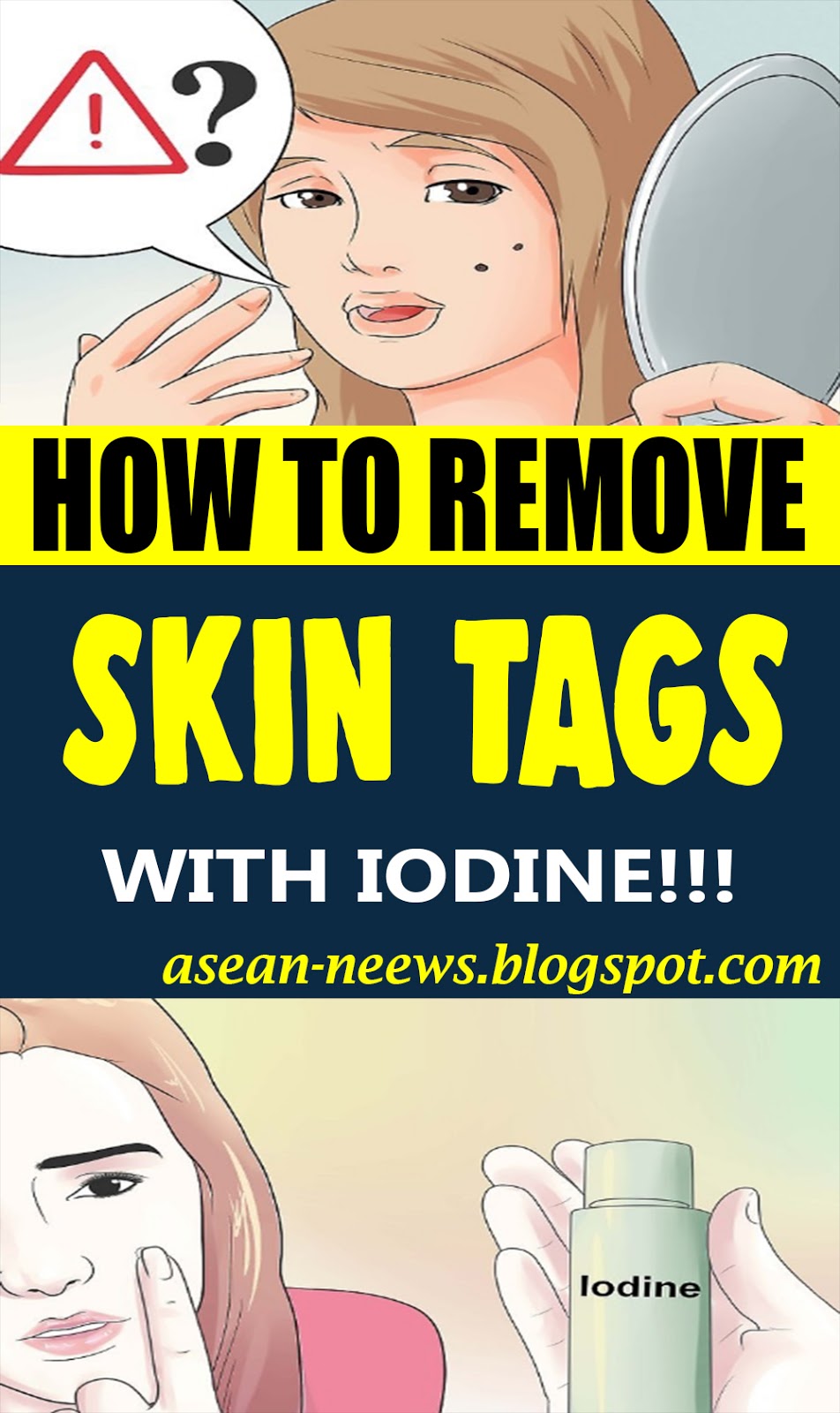 How to Remove Skin Tags Safely with Iodine? BEAUTY HACKS