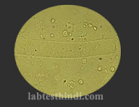 Urine Microscopic - waxy casts