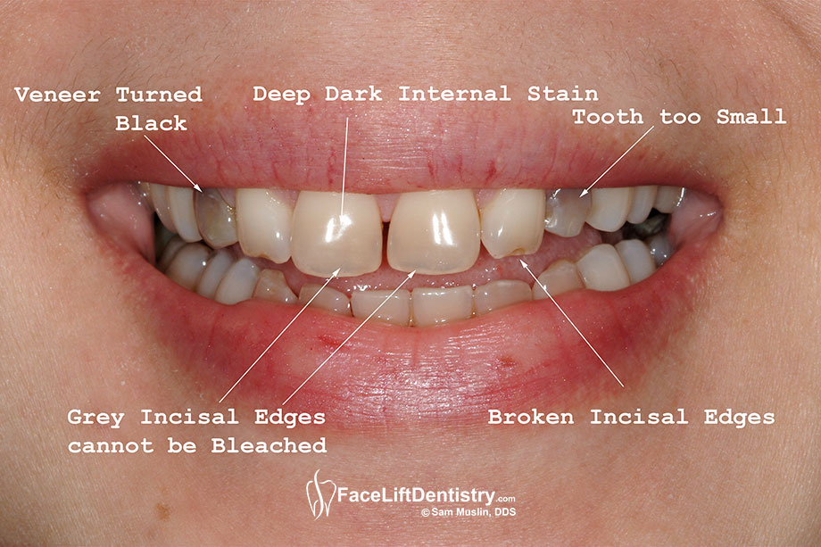 Tetracycline Stains On Teeth Long Live Fitness