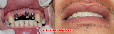 có nên cắm ghép răng implant không -9 có nên cắm ghép răng implant không -9