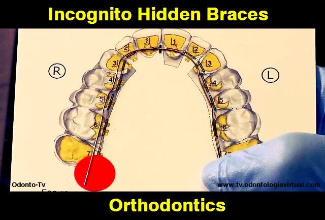 ORTHODONTICS: Incognito Hidden Braces