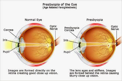 Pengertian, Patofisiologi, Etiologi, dan Pengobatan Kelainan Presbiopi Pada Mata