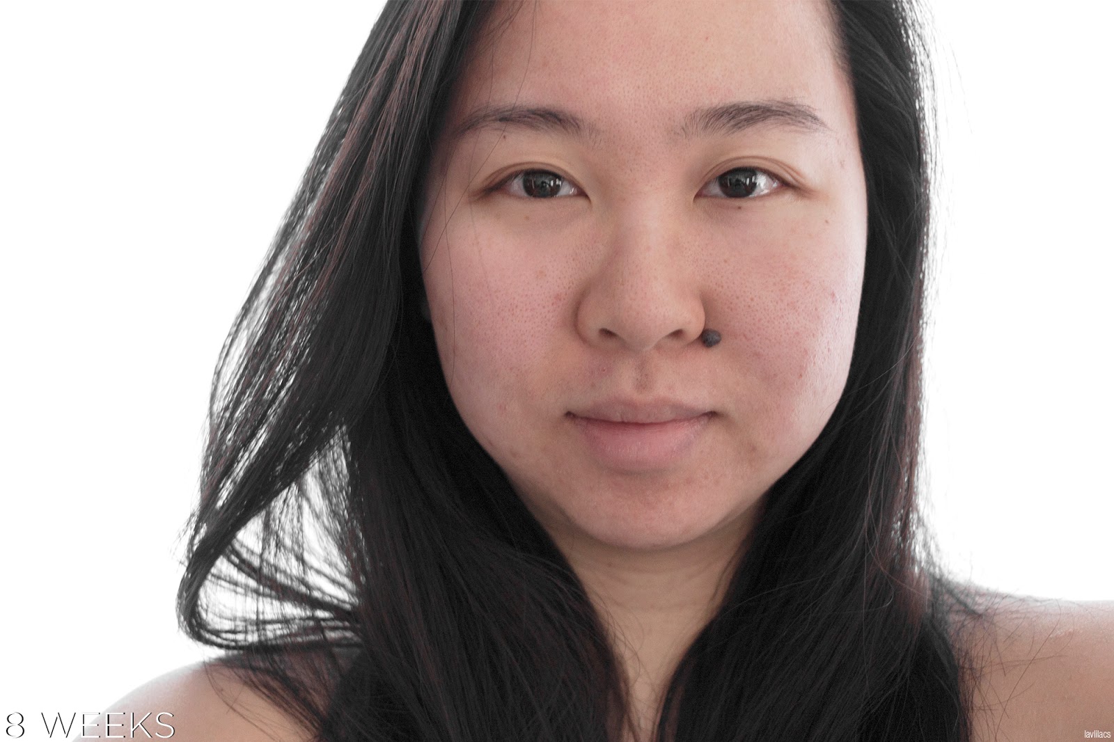 tria Hair Removal Laser Facial Hair 8 Weeks