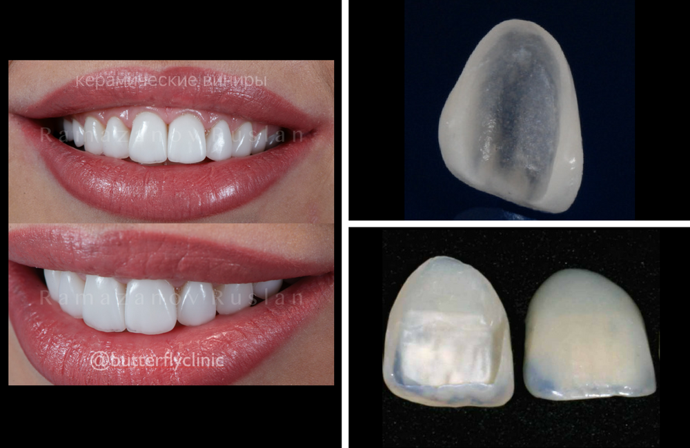 veneer dental