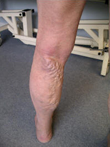 Varicose Veins