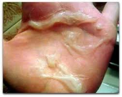 Foto Obat Alami Penis Pria Keluar Nanah Di Apotik