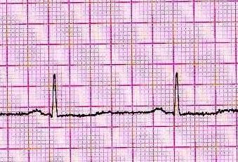 ECG electrocardiogram -1