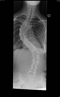 My scoliosis xray before surgery
