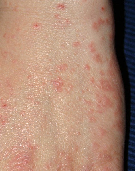 Obat Scabies Untuk Manusia Obat Scabies Untuk Manusia