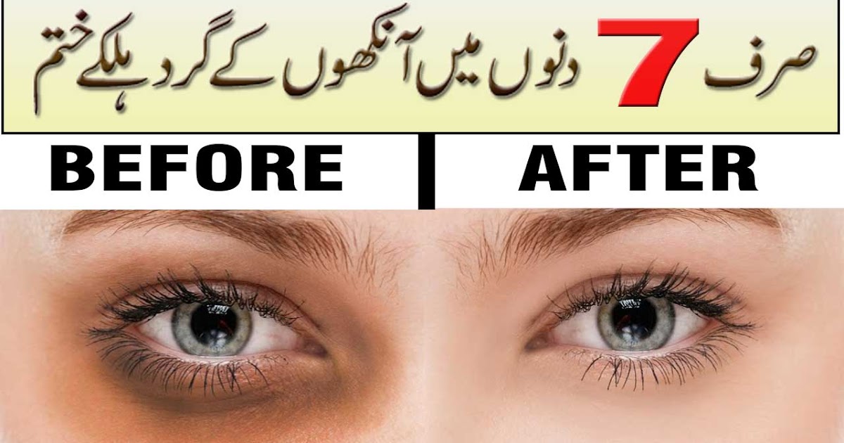 How to Remove Under Eye Dark Circles in 7 days ! Ankhon K Siya Hlky