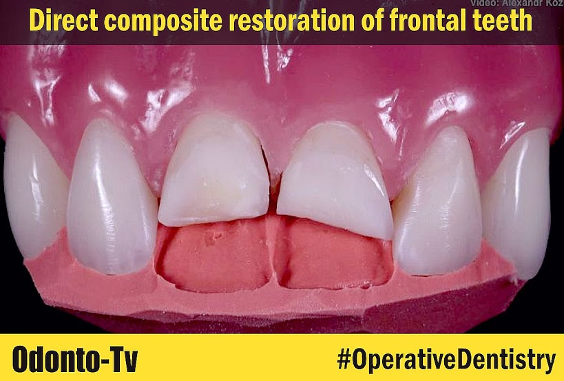 OPERATIVE DENTISTRY Direct composite restoration of frontal teeth