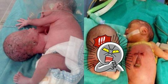 Kepala Bayi Kedua Tumbuh Diperut, Tak Disangka Saat Di Bedah Yang Terjadi Mengejutkan! Kepala Bayi Kedua Tumbuh Diperut, Tak Disangka Saat Di Bedah Yang Terjadi Mengejutkan!