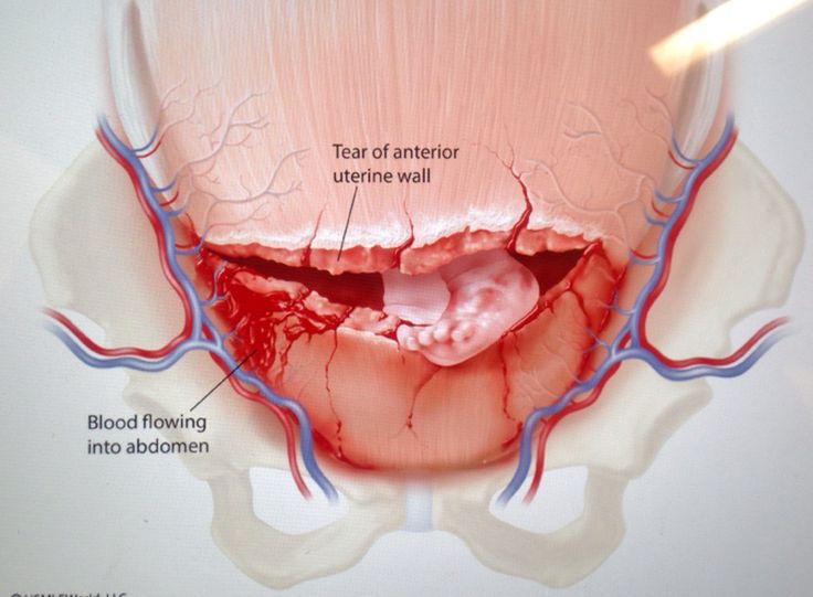 presentations of uterine rupture