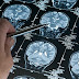 Neuroscientist Shows What Fasting Does To Your Brain and Big Pharma Won’t Study It
