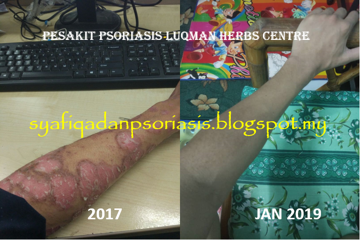 lake tus khakassia reviews of psoriasis kezelés)