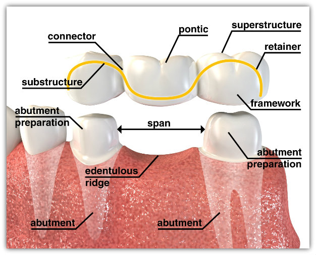 Ribbond Single Visit Bridge Education Articles
