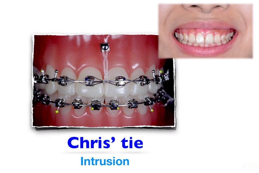 ORTHODONTICS Intrusion Chris Chang OdontoTv