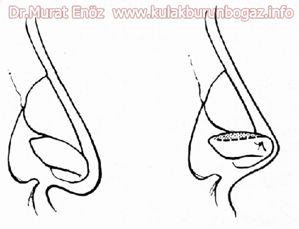 Nose Tip Plasty Operation in Istanbul - Nose Tip Plasty Turkey - Nose Tip lifting in Istanbul - Tip plasty in İstanbul - Nose Tip Reshaping in Istanbul - Nose Tip Surgery in Turkey - Open Technique Tip Plasty Operation in Istanbul - Important Role of The "Columellar Strut Graft" on Nasal Tip Elevation With Nasal Support - Nasal Tip Plasty With "External Strut Graft" - How External Strut Graft Is Placed? - How Does The External Strut Graft Change The Nasal Tip Appearance? - Advantages of External Strut Graft Technique? - Nasal Tip Elevation With "Suspension Stitches" - "Nasal Tip Plasty": The Most Crucial Part of Rhinoplasty Procedure - Suture Tip Plasty - Non-Surgical Tip Plasty Technique: Nasal Filler Materials - Natural Filler Materials For Nasal Tip Plasty: Cartilage Membranes - Postoperative Patient Care After Nasal Tip Plasty