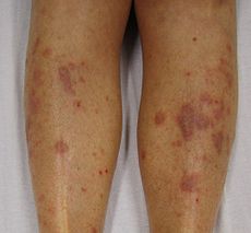 lichen simplex behandling