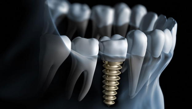 dental implants melbourne dental implants melbourne