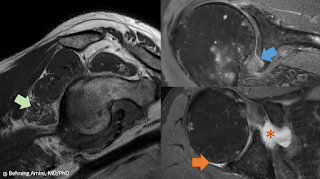 MRI of anatomy of the axillary nerve and its relationship to the joint capsule in adhesive capsulitis. MRI of anatomy of the axillary nerve and its relationship to the joint capsule in adhesive capsulitis.