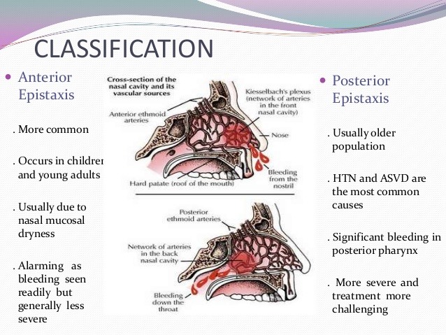 Dr Ajays Homeopathy : HOMEOPATHIC APPROACH TO EPISTAXIS (NOSE BLEED) Dr Ajays Homeopathy : HOMEOPATHIC APPROACH TO EPISTAXIS (NOSE BLEED)