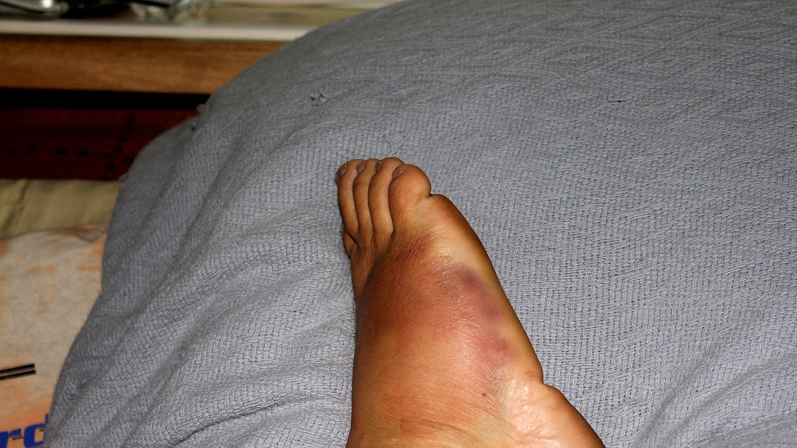 How To Rehab An Foot Bruise