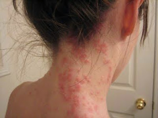 herpetiform dermatitis duhring