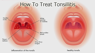 How To Treat Tonsillitis