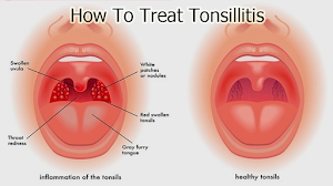 How To Treat Tonsillitis How To Treat Tonsillitis