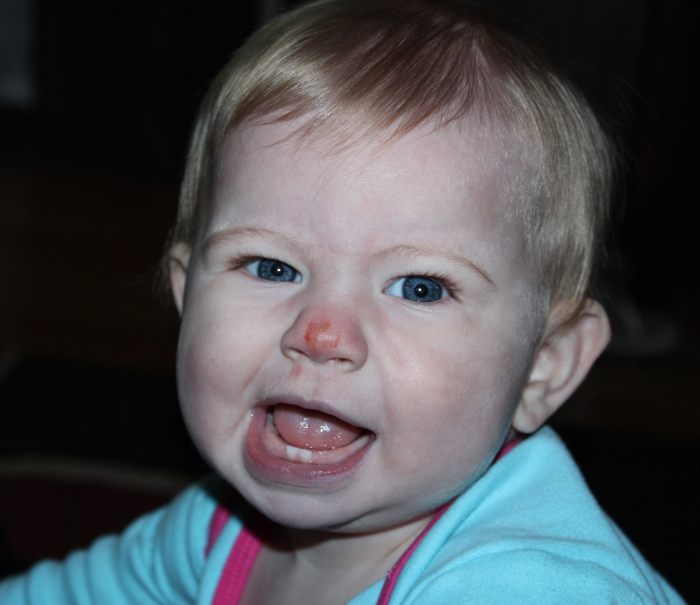 Carpet Burn On Face Carpet Vidalondon